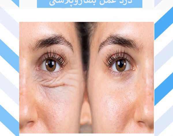 حقایقی از درد عمل بلفاروپلاستی که باید بدانید !
