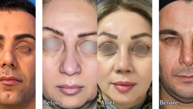 نحوه شستشو صورت بعد از جراحی لیفت صورت | نحوه شستن صورت بعد از لیفت