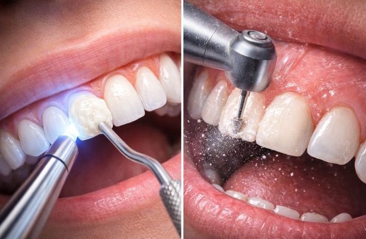 کامپوزیت بدون تراش دندان: واقعیت یا تبلیغ؟