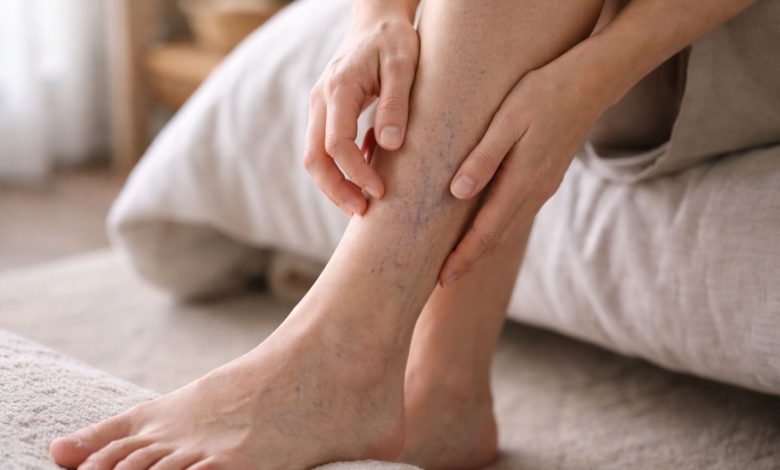 راهنمای فوری کنترل خارش واریس؛ از کمپرس سرد تا مراقبت پوستی
