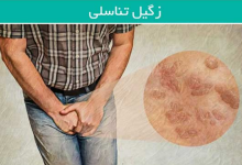 خطرات ابتلا به زگیل تناسلی