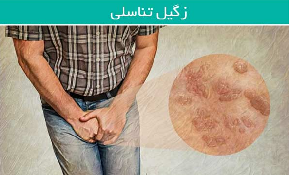 خطرات ابتلا به زگیل تناسلی