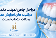 لمینت دندان چگونه انجام می شود؟ صفر تا صد مراحل لمینت دندان