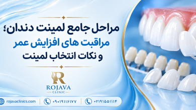 لمینت دندان چگونه انجام می شود؟ صفر تا صد مراحل لمینت دندان