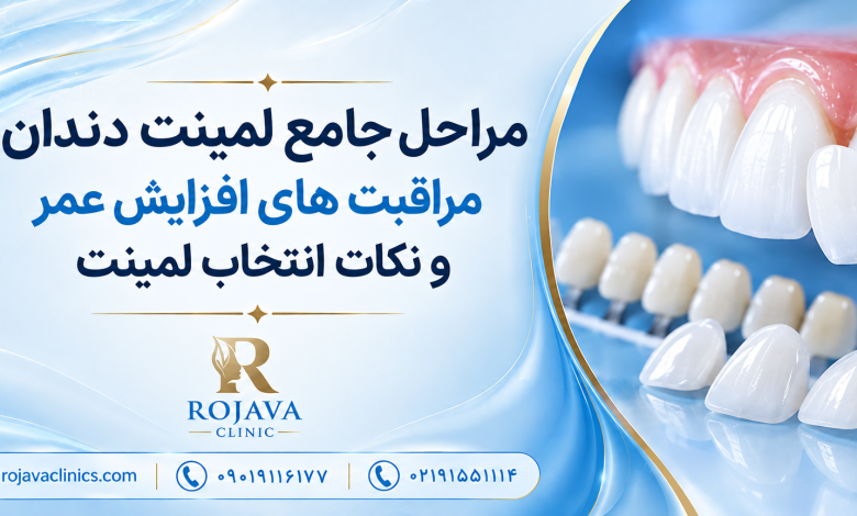 لمینت دندان چگونه انجام می شود؟ صفر تا صد مراحل لمینت دندان